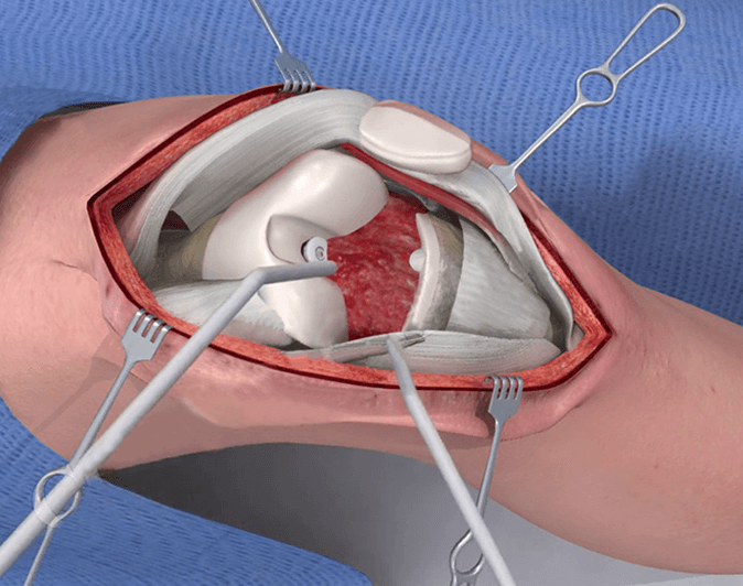 3D Surgical Animation